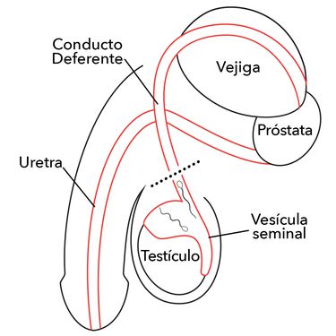 vasectomy-spanish-whitebg.jpg__500x375_q80_subsampling-2